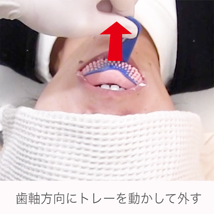 印象採得 07.トレーの外し方、印象採得後のチェックポイント