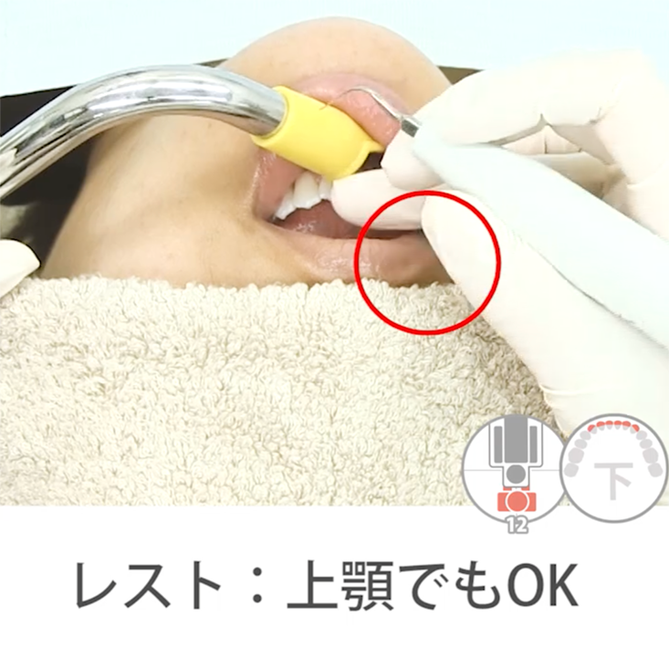 スケーリング実践編 04.下顎前歯部唇側その4